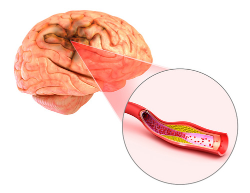 3D-Darstellung der Hirngefäße bei einem Schlaganfall