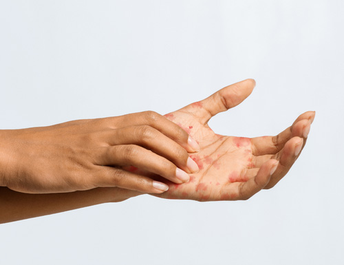 Dermatitis an den Händen